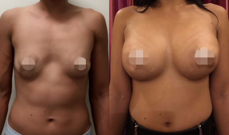 Breast Augmentation CosMediTour