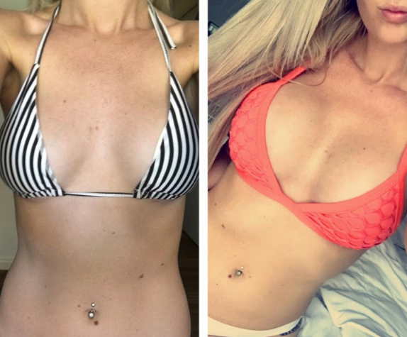 Breast Revision Before and After #8