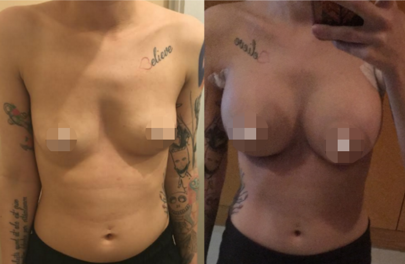 Bangkok Breast Augmentation Results