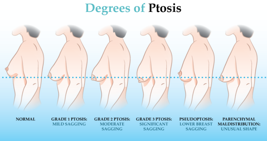 Breast Ptosis, Droopy Breasts, Saggy Breasts
