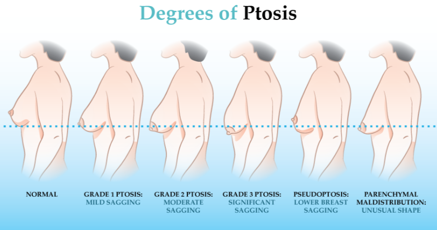 Los Deline  Injectable Volumizing Implant - BREAST PTOSIS (SAGGING):  CAUSES AND CLASSIFICATION