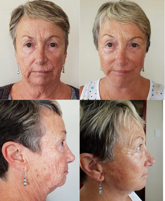 Eyelid Lift and Facelift Before & After #12