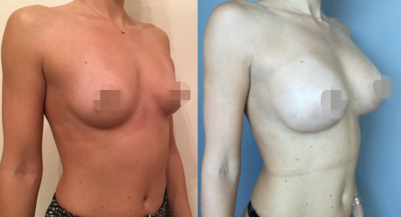 Breast Augmentation CosMediTour