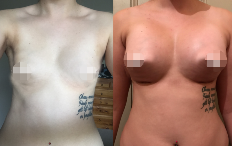 Breast Augmentation CosMediTour