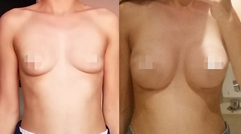 Breast Augmentation CosMediTour