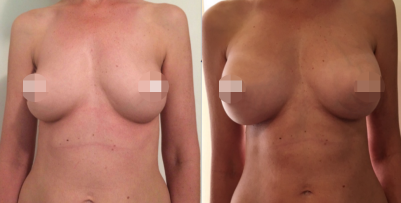 Breast Augmentation CosMediTour