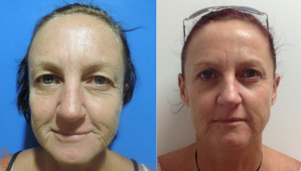 Eyelid Lift Before & After #14