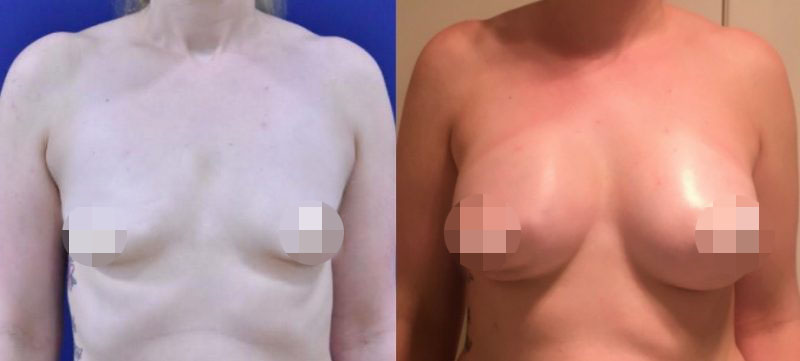 Breast Augmentation CosMediTour