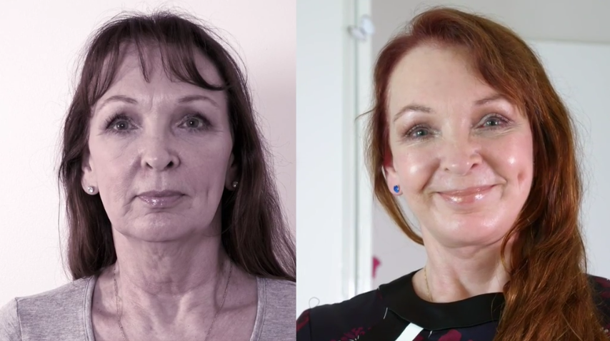 Eyelid Lift and Facelift Before & After #13