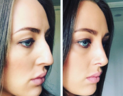 Rhinoplasty