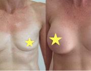 Breast Augmentation