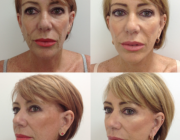 Face Lift