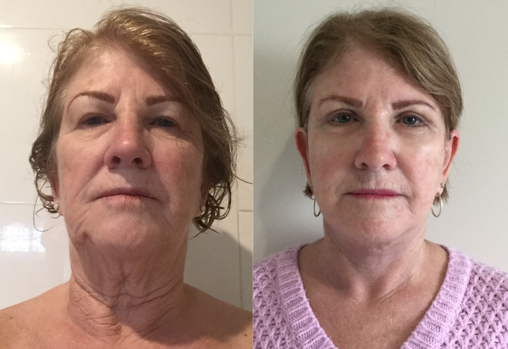 Eyelid Lift and Facelift Before & After #15