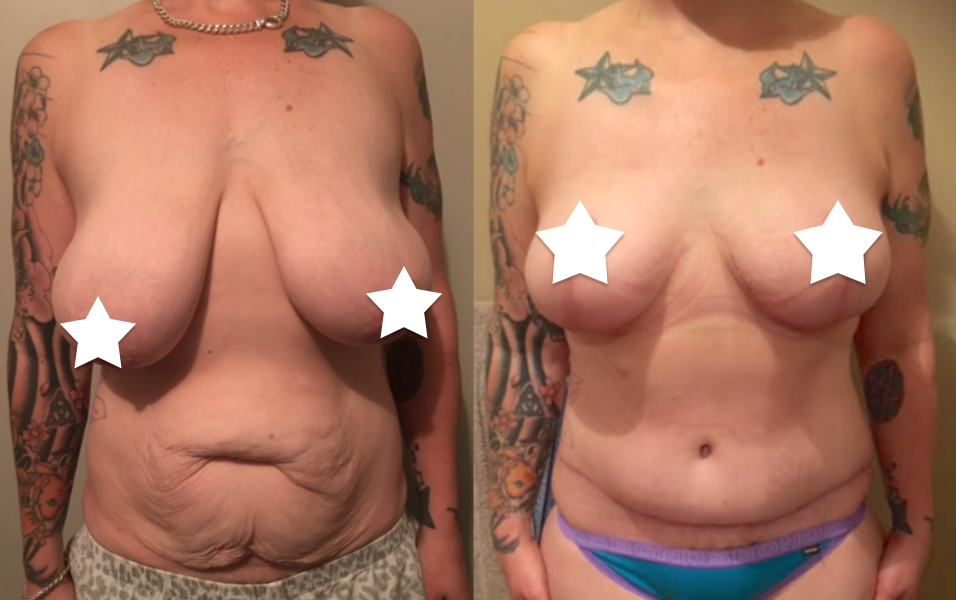 Mummy Makeover with Breast Reduction Before & After #9