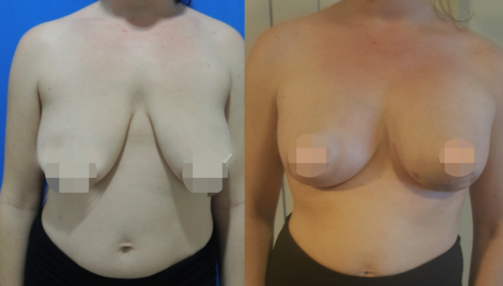 Breast Augmentation CosMedITour