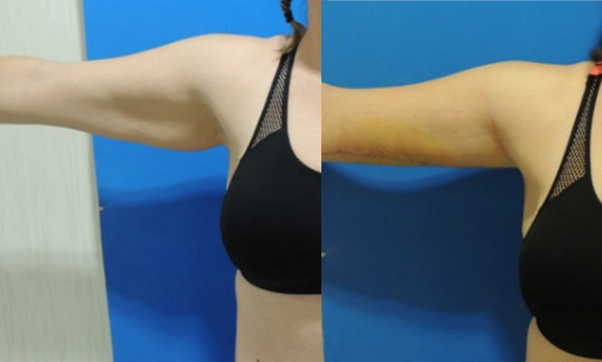 Arm Lift Before and After #10