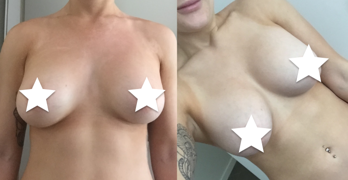 Breast Revision Before and After #12