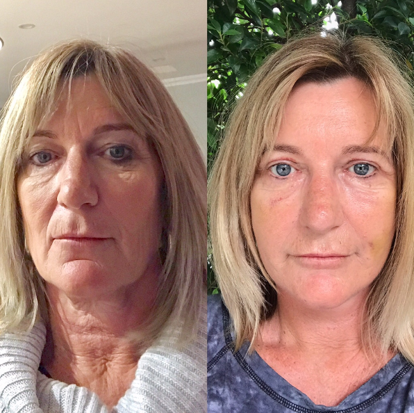 Eyelid Lift and Facelift Before & After #16