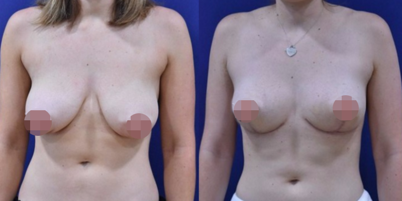 Breast Lift Before & After #7