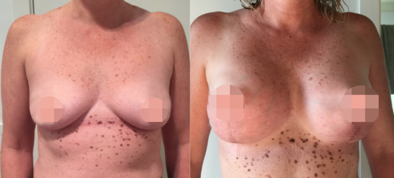 Breast Augmentation CosMediTour