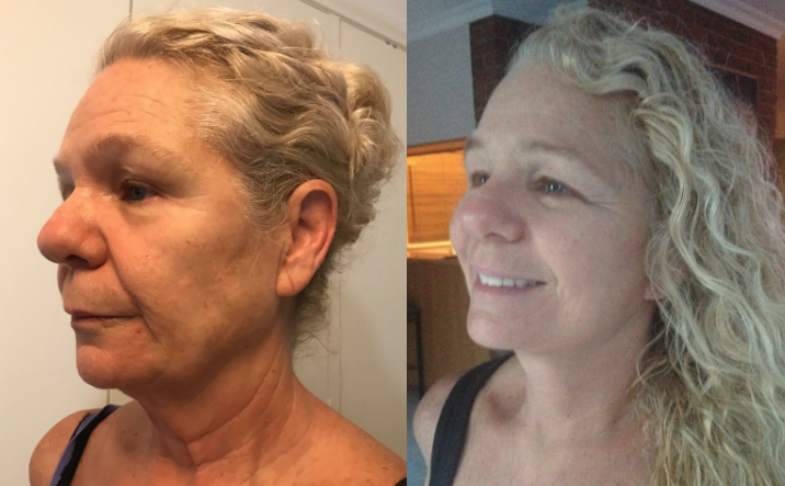 Facelift and Eyelid Lift Before and After #21