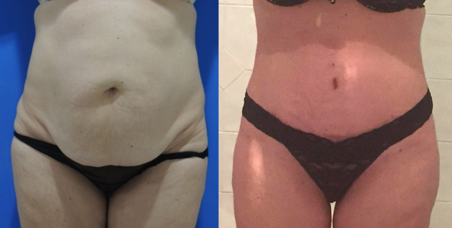 Tummy Tuck Before & After #90