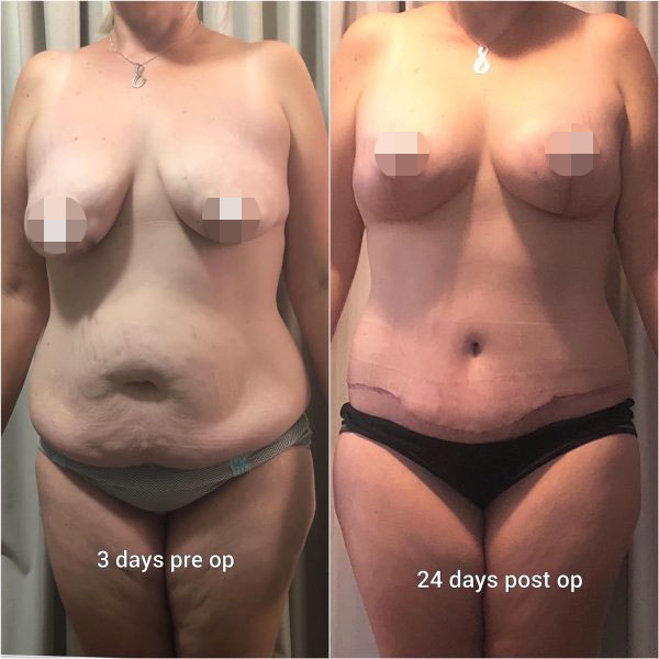 Mummy Makeoverwith Breast Augmentation & Lift #45