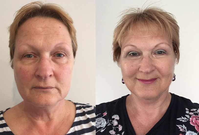 Facelift Before and After #22