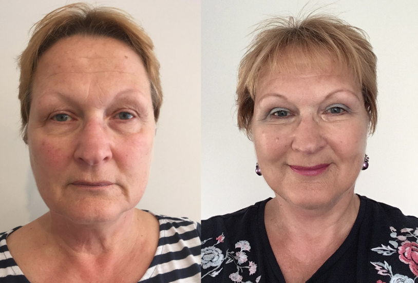 Facelift - Before and after photo