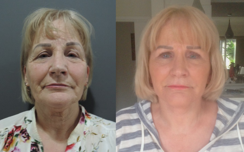 Facelift Lift Before and After #23