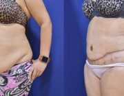Belt Lipectomy with Liposuction