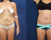 Extended Tummy Tuck and Belt Lipectomy
