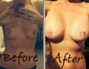 Breast Augmentation