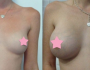 Breast Augmentation