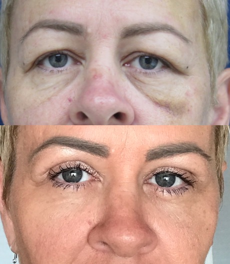 Eyelid Lift Before & After #18