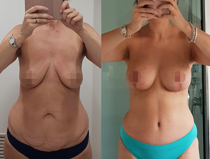 Mummy Makeover with Breast Augmentation & Lift #47