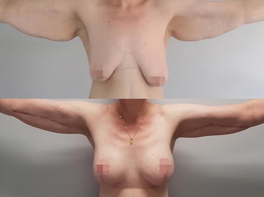 Breast Augmentation and Lift with Arm Lift Before and After #11