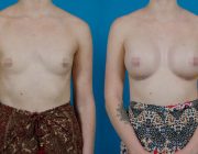 Breast Augmentation CosMediTour