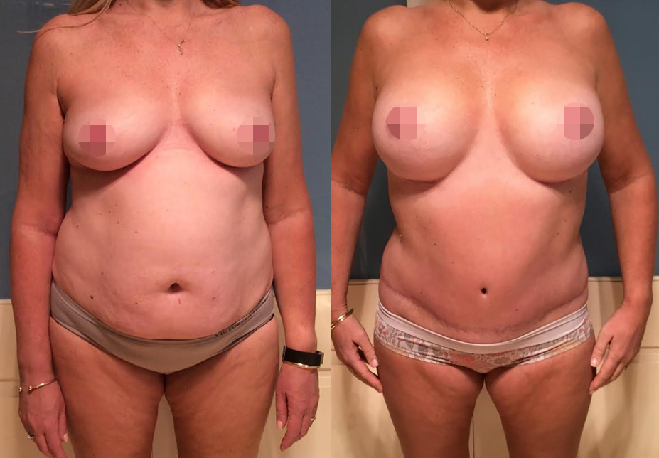 Mummy Makeover with Breast Augmentation & Lift #49