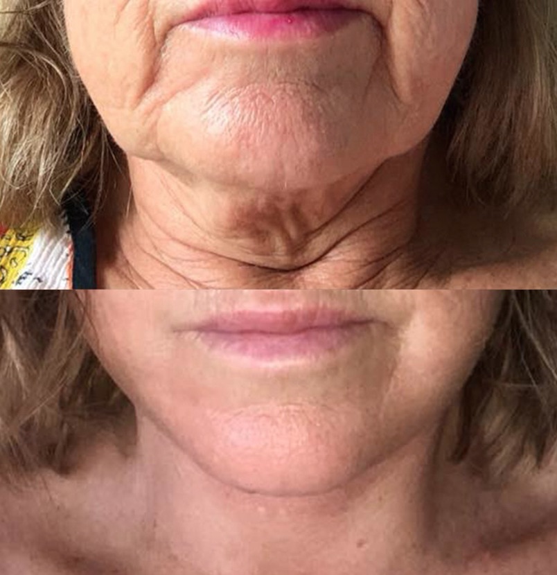 Facelift - Before and after photo