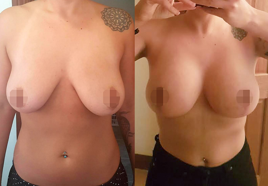 Exceptional Breast Lift + Augmentation Results by Dr Sanguan