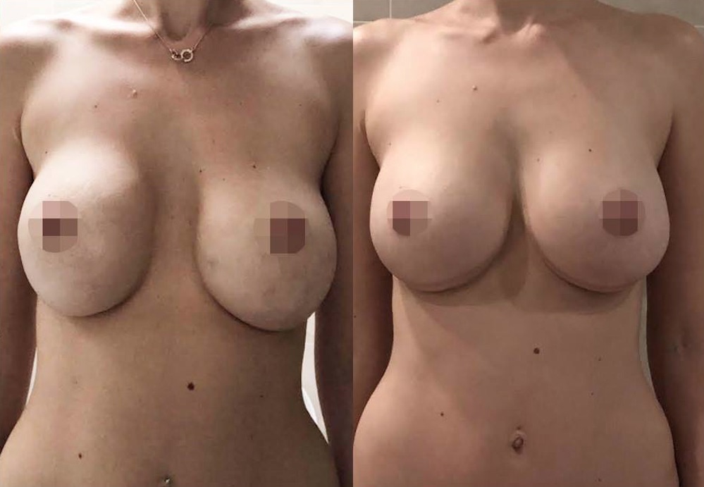 Breast Revision Before and After #13