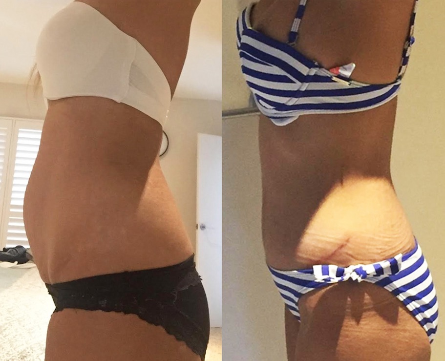 Tummy Tuck Before & After #93