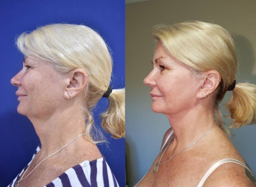 Tric Travels to Thailand for Plastic Surgery with Dr Rushapol