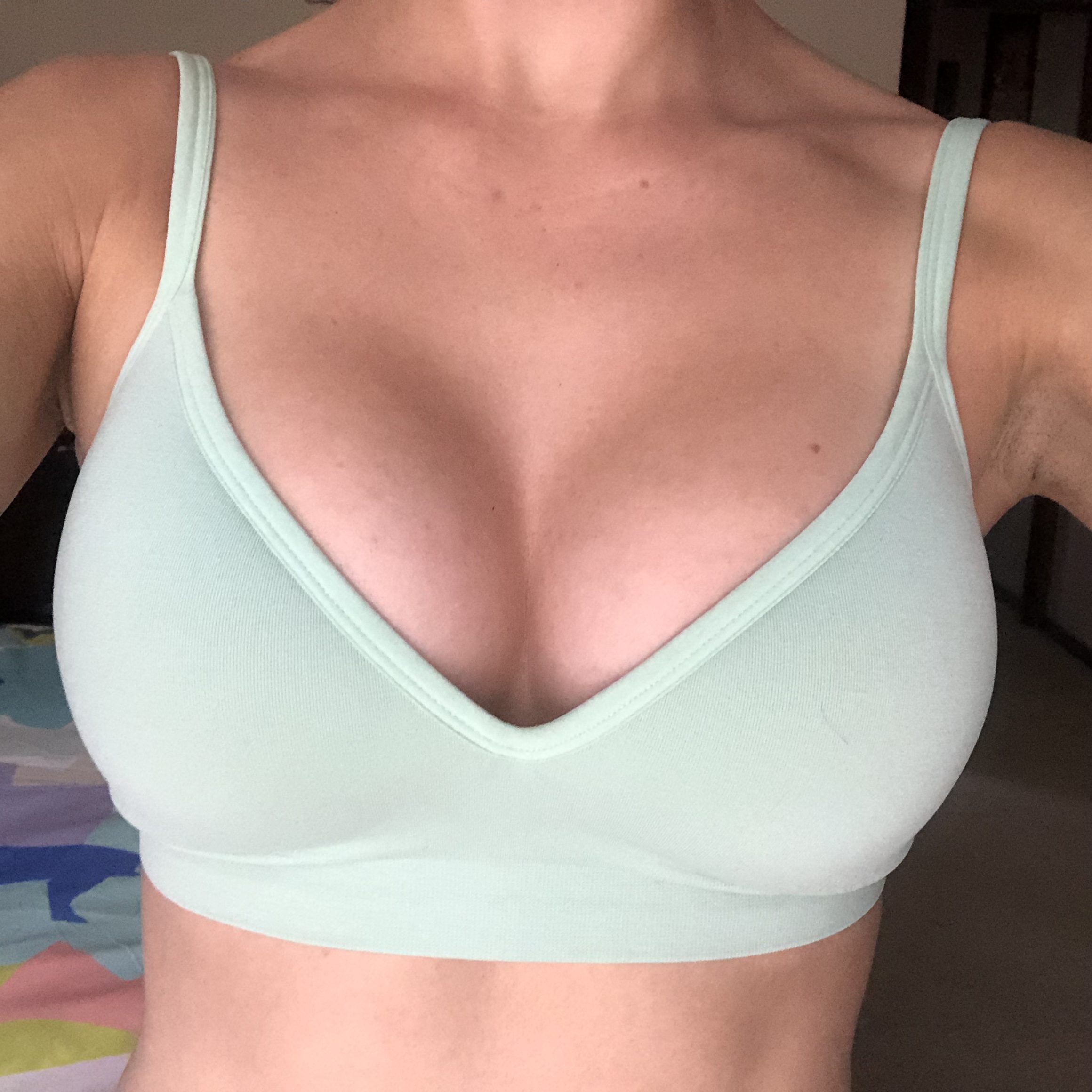 Breast Augmentation Before & After #308