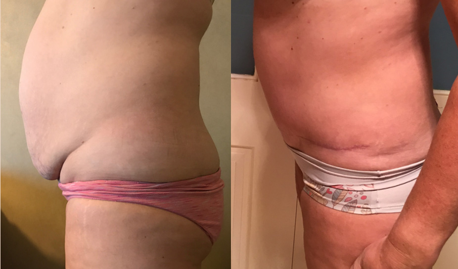 Tummy Tuck Before & After #94