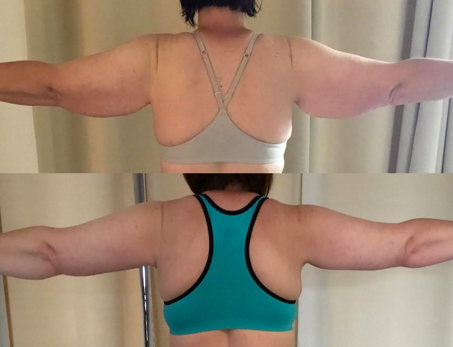 Arm Lift Before and After #15