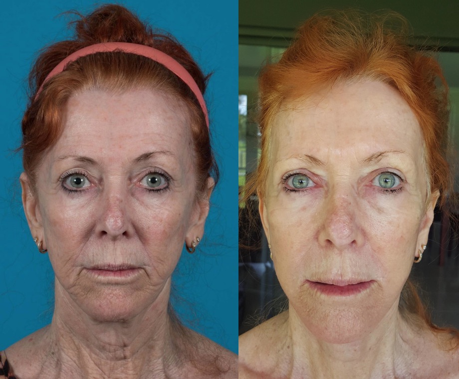 Facelift and Eyelid Lift Before and After #30