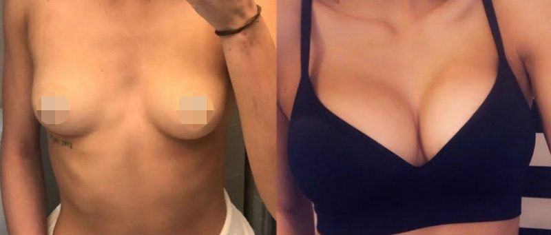 Breast Augmentation Before & After #310