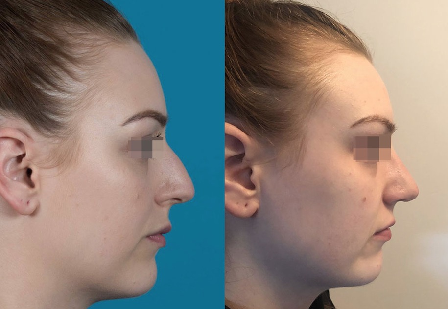 Impressive Rhinoplasty Nose Correction Results in Bangkok